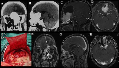 Clinial Features, Individualized Treatment and Long-Term Surgical Outcomes of Skull Base Meningiomas With Extracranial Extensions